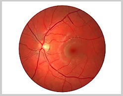 retina_vista_glaucoma